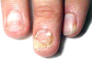Негрибковые болезни ногтей