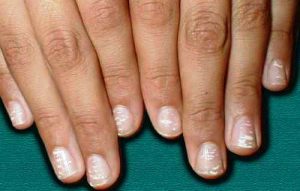 Фото белых пятен на ногтях пальцев рук