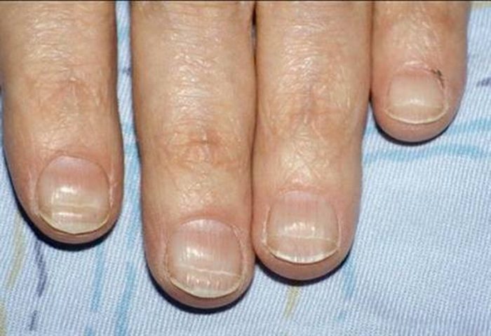 6 способов избавиться от ребристых ногтей: различаем горизонталь и вертикаль