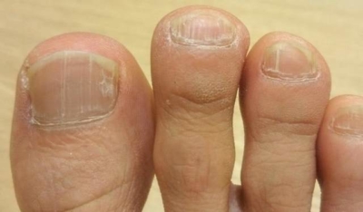 Трещина на ногте: причины, ремонт ногтя