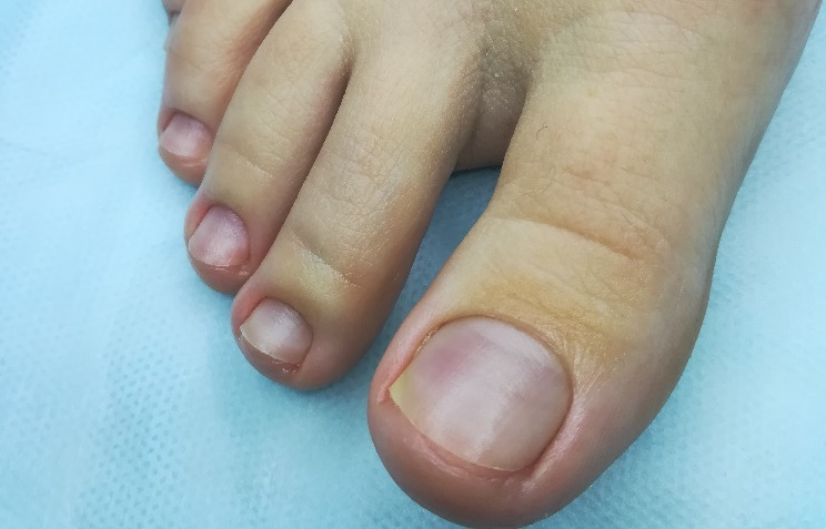 Подногтевая гематома на большом пальце ноги фото