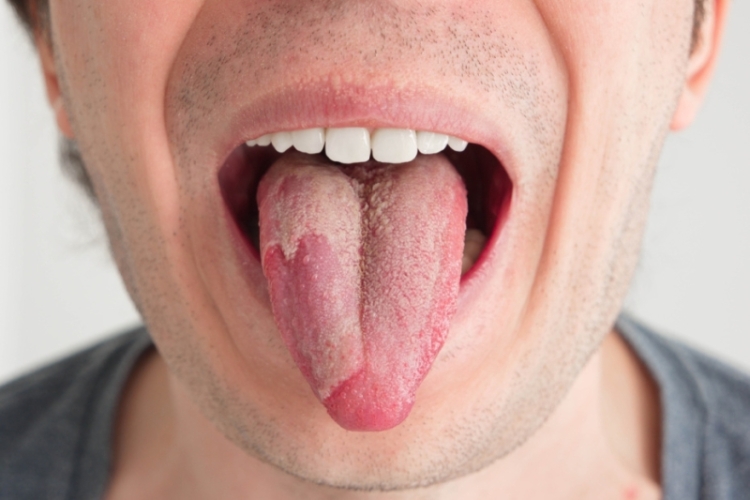 Живет в каждом из нас: чем опасен кандидоз, симптомы, как не заболеть